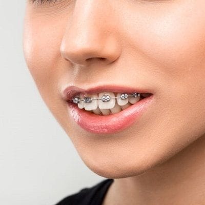 Occlusal Bite Problems in Dubai & Abu Dhabi UAE Bite Solution Cost