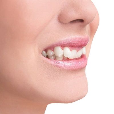 Overlapping Teeth Treatment in Dubai & Abu Dhabi Overlapping Cost