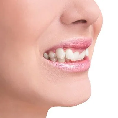 Overlapping Teeth Treatment in Dubai & Abu Dhabi Overlapping Cost