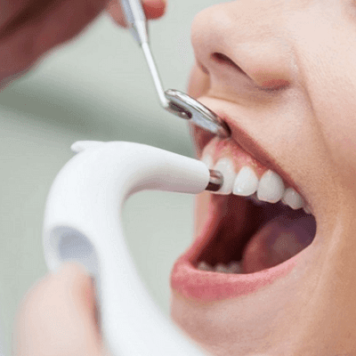 Teeth Polishing & Scaling