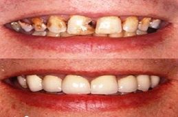best-dental-implants-clinic-in-uae