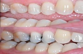 tooth-filling-cost-in-dubai