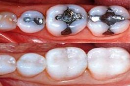 tooth-filling-cost-in-uae