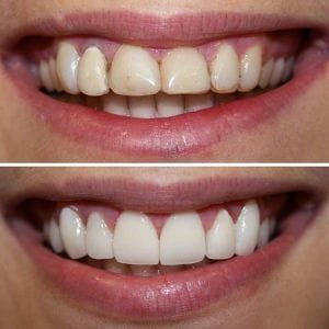 Best Composite Veneers in Dubai & Abu Dhabi