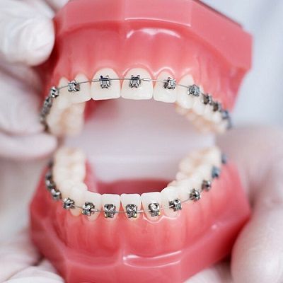 Best Metal Braces in Dubai & Abu Dhabi Cheap Dental Braces Cost