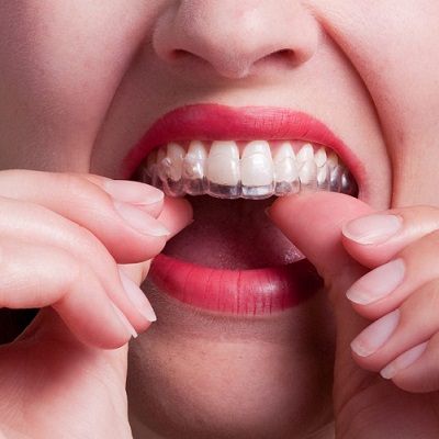 Best Teeth Retainer Treatment in Dubai UAE Teeth Retainer Cost