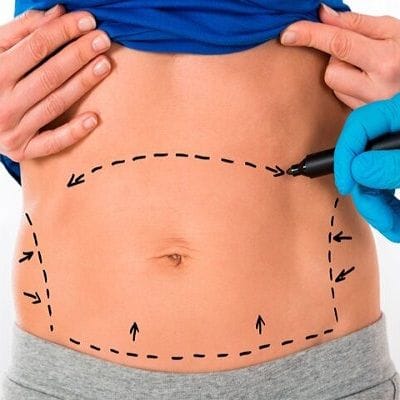 Body Jet Liposuction Cost in Dubai