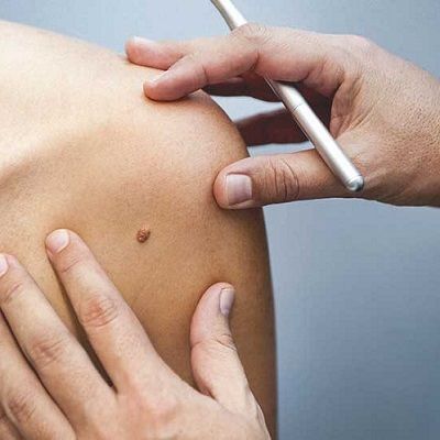 Can Moles be Removed with Laser in Dubai