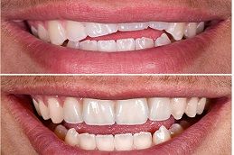Crooked Teeth Treatment in Dubai & Abu Dhabi