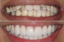 Crooked Teeth Treatment in Dubai