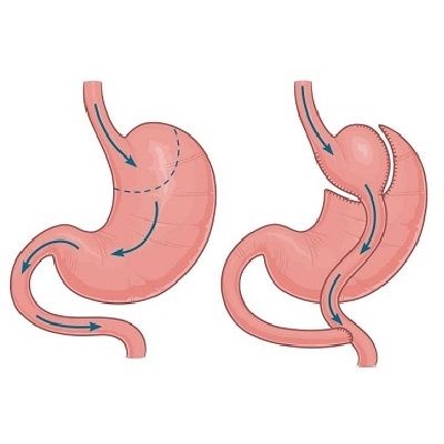 Gastric Bypass in Dubai & Abu Dhabi Mini Gastric Bypass UAE Cost