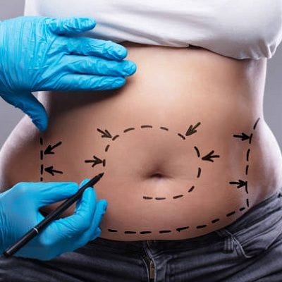 How much GPS Laser Liposuction Cost in Dubai