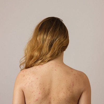 How to Get Rid of Back Acne Scars