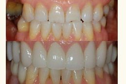 Periodontics & Gum Disease Treatment Dubai