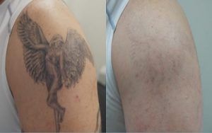 Picosure Tattoo Removal in Dubai & Abu Dhabi