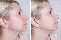 Pimples Treatment in Dubai & Abu Dhabi