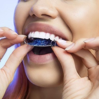 Retainers Cost in Dubai