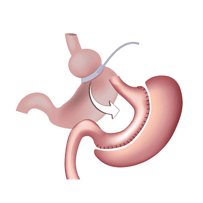 Revision Bariatric Surgery in Dubai