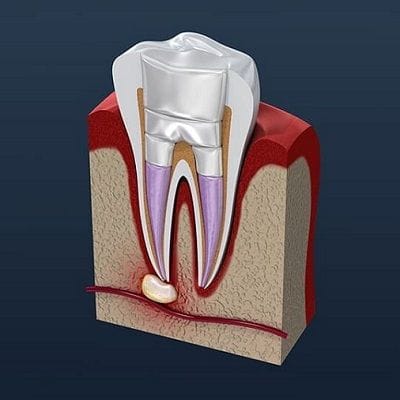 Root Canal Infection & Pain Treatment in Dubai UAE Root Canal Cost