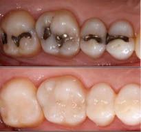 SMART - Dental Amalgam Removal in Dubai