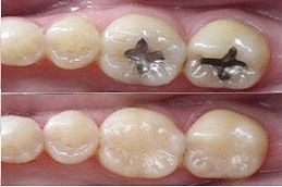 SMART - Dental Amalgam Removal