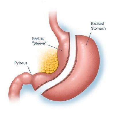 Sleeve Gastrectomy in Dubai & Abu Dhabi Gastric Sleeve Surgery UAE