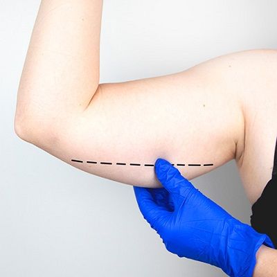 Arm Liposuction Cost in Dubai | Enfield Royal Clinic