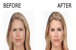 Botox Injection for wrinkles Treatment
