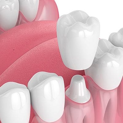 Ceramic Crowns Cost in Dubai