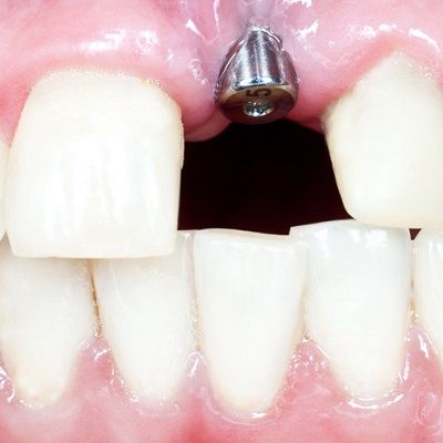 Dental Implant Infection in Dubai & Abu Dhabi Enfield Clinic
