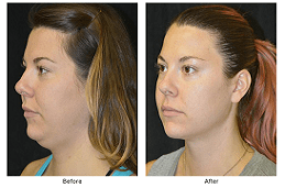 Double Chin Liposuction in Dubai & Abu Dhabi