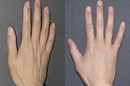 Hand Rejuvenation Treatment in Dubai & Abu Dhabi