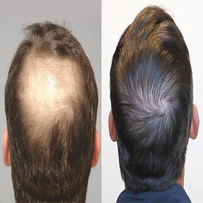 How Many Prp Sessions Are Needed For Hair Growth in Dubai & Abu Dhabi