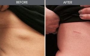 Lipoma Treatment in Dubai & Abu Dhabi