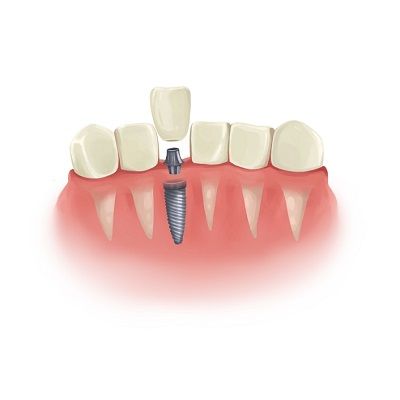 Loose Dental Implant