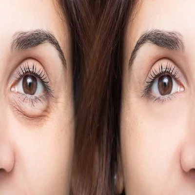 PRP For Dark Circles