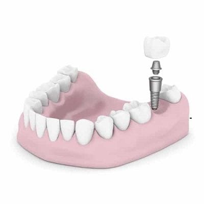 Same Day Dental Implants in Dubai & Abu Dhabi Enfield Clinic