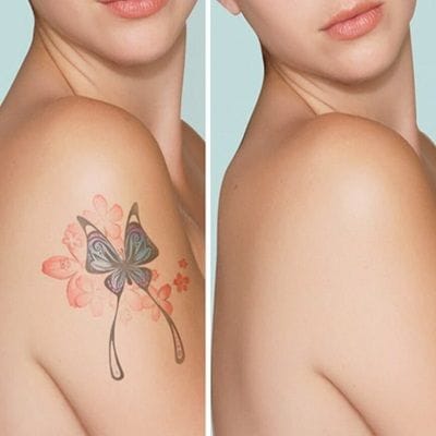 Can You Completely Remove a Tattoo with Laser?