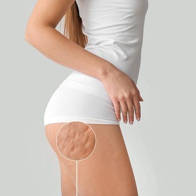 Cellulite Treatment at Home