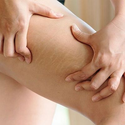 Cellulite Treatment for Front of Thighs