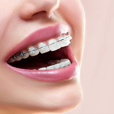 Does Ceramic Braces Take Longer in Dubai