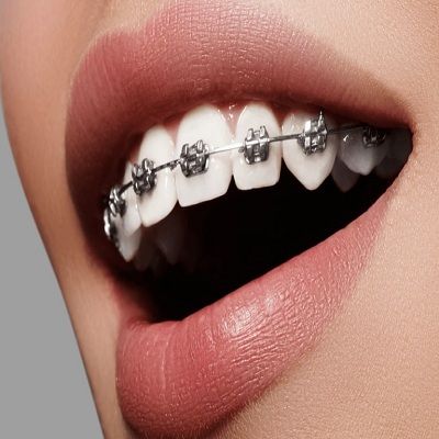 Everything You Need to Know About Braces in Dubai