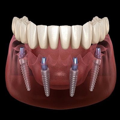 Full Mouth Rehabilitation With Dental Implants in Dubai & Abu Dhabi