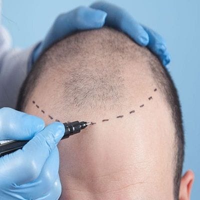 Hair Transplant Cost per Graft in Dubai & Abu Dhabi | Hair Transplant Cost