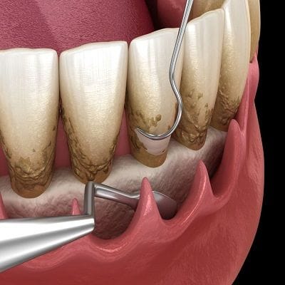 How Fast Does Periodontal Disease Progress in Dubai & Abu Dhabi