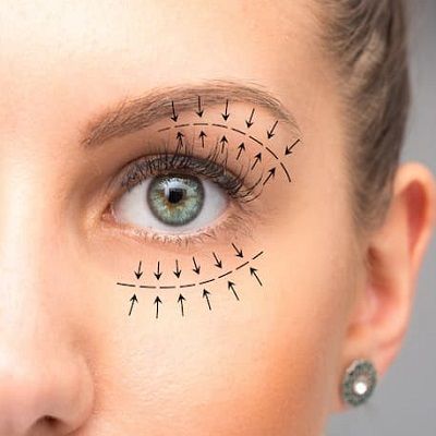 How Long Does Non-Surgical Blepharoplasty Last | blepharoplasty cost