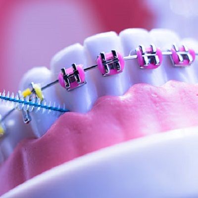 How long does metal braces take to straighten teeth in Dubai