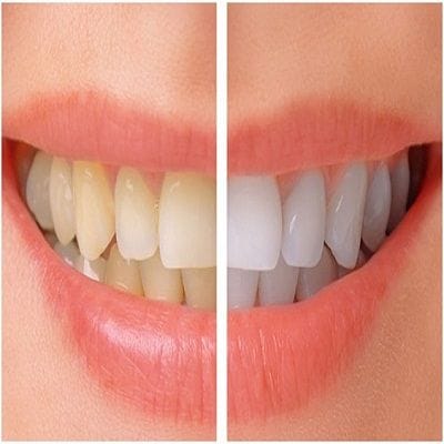 How to get rid of yellow teeth in Dubai