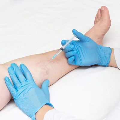 Is Sclerotherapy in Dubai, Abu Dhabi & Sharjah Permanent?