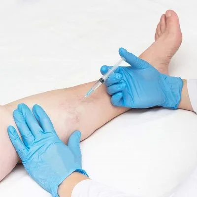 Is Sclerotherapy Permanent?